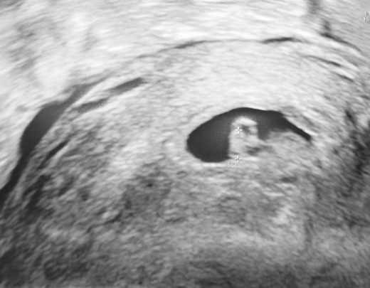 Ultraschallbild im 1 Trimester